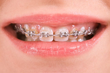 A woman with braces