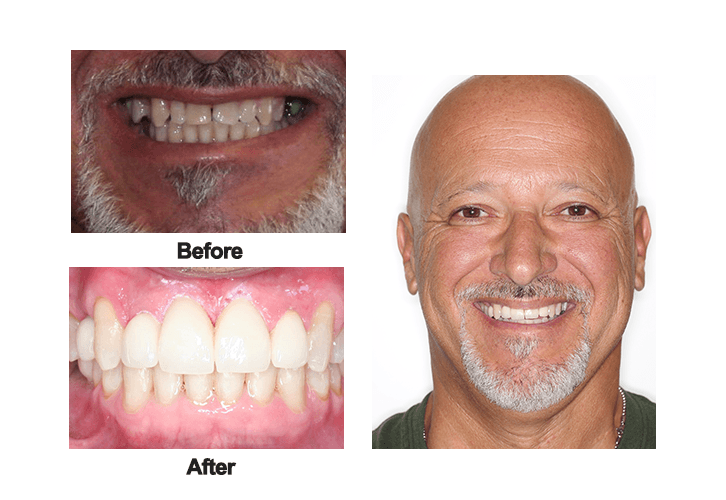 Angelo Bamasuto smile before and after