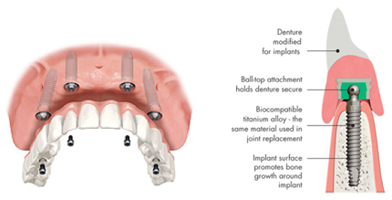 Implant-supported Dentures