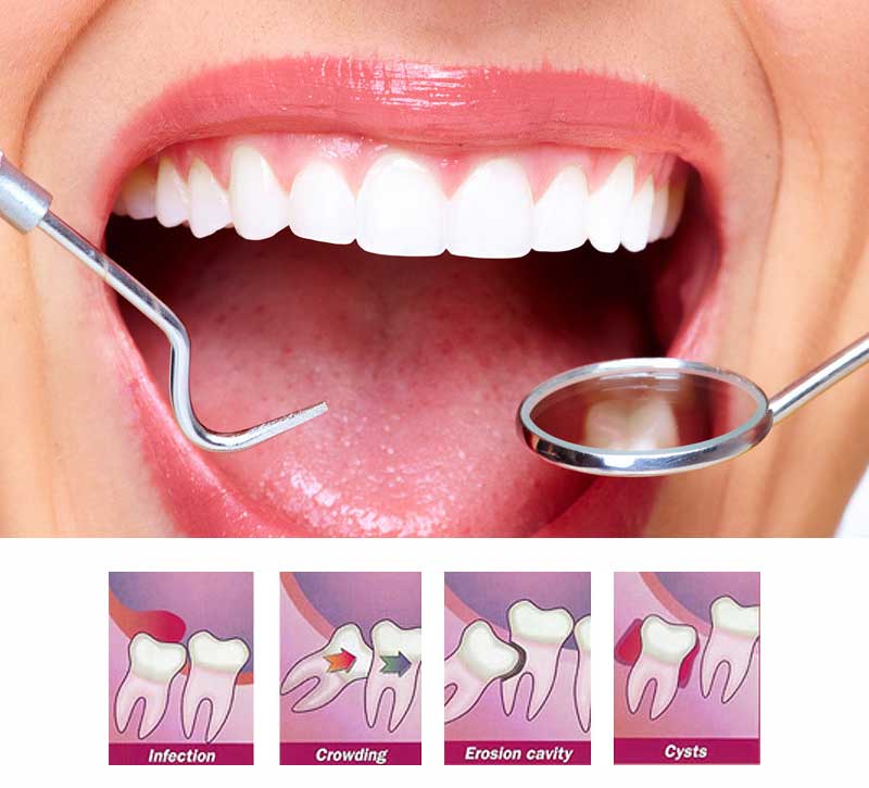 tooth extraction step by step