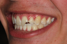 Before image of patient without bonding