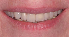 Patient Case 7 after dental implants