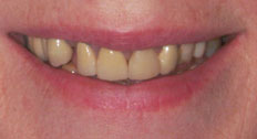 Patient Case 7 before dental implants