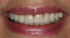 Case 3 after dental implants