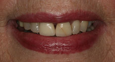 Case 3 before dental implants