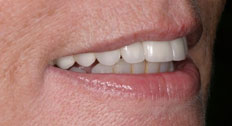 After dental implants Patient Case 5