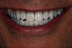 After Invisalign patient case 3