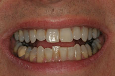 Before Invisalign patient case 3