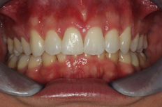 patient's front teeth after treatment