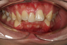 patient's front teeth before treatment