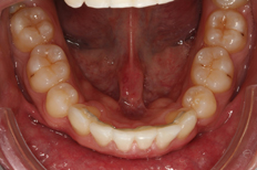 Patient's lower teeth after invisalign