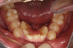 Patient's lower teeth before invisalign