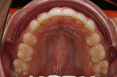 Patient's upper teeth after treatment