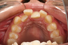 Patient's upper teeth before treatment