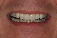 Veneers Patient Case 2 After