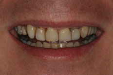 Veneers Patient case 2 before