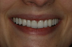 Porcelain Veneers case after