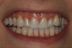 Porcelain Veneers case 3 before