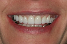 Patient Case 4 Veneers after treatment