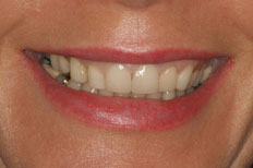 Porcelain Veneers patient case 4 before treatment