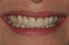 Veneers Patient Case 5 After