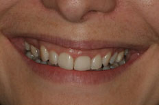 Veneers Patient Case 5 before