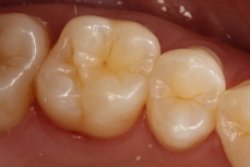 composite filling 3