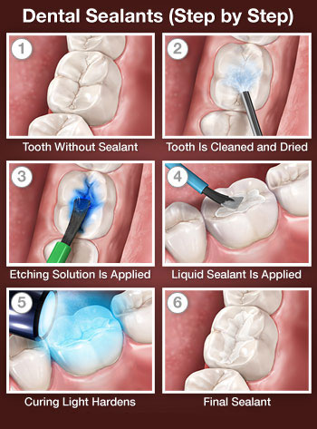 Step by Step image of Dental Sealants