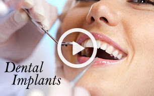 Dental Implants Thumbnail