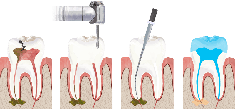 root canal therapy explained