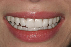 Elighten whitening Patient Case 1 after