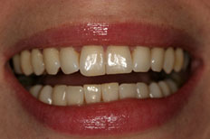 Before Whitening Patient Case 1