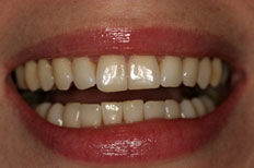 Elighten whitening Patient Case 1 before