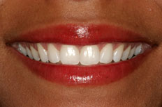 After Whitening Patient Case 2