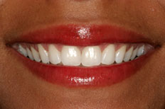 Elighten whitening Patient Case 2 after