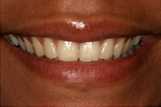 Elighten whitening Patient Case 2 before